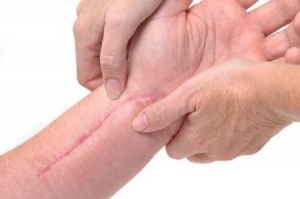 Cicatrici: come influiscono sulla postura e come trovare giovamento con l&#039;osteopatia